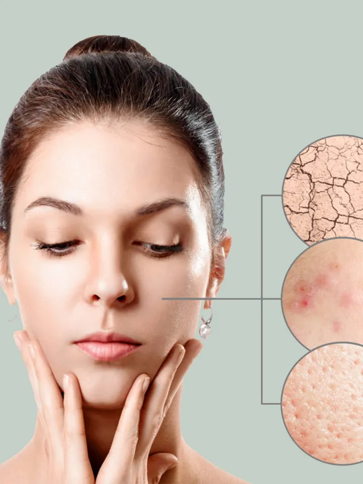 Metrogil gel Metronidazole STOP ACNE cream