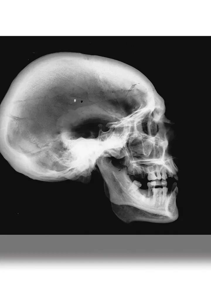 X-ray of a human skull.