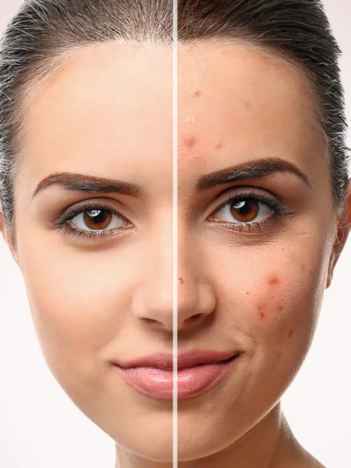 Natural Kartalin Skin Cream for Psoriasis and Eczema 100ml